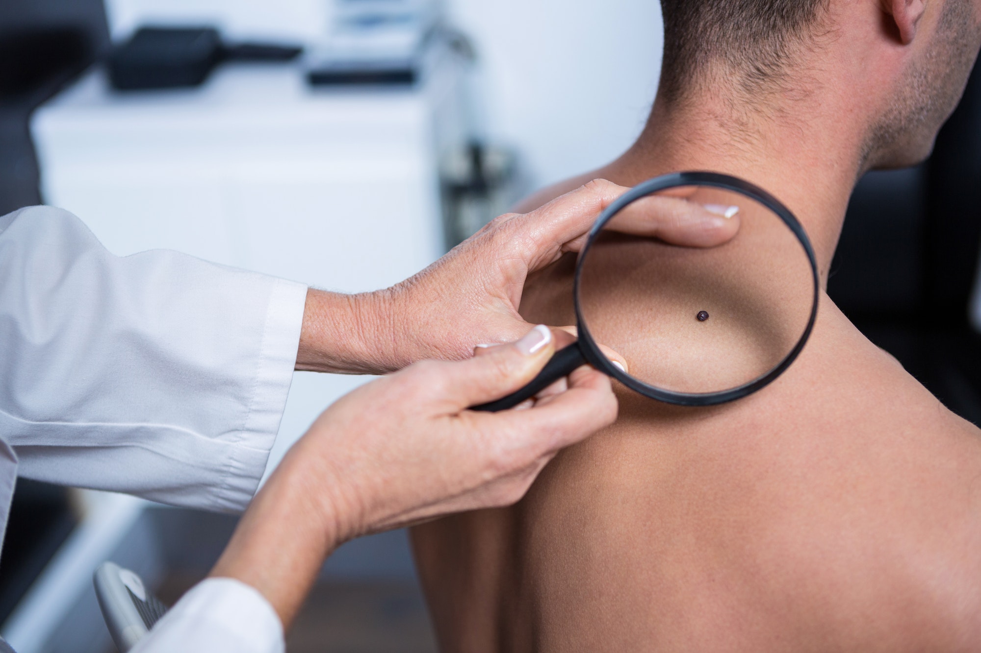 Dermatologist examining mole with magnifying glass